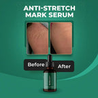 Stretch Mark Serum - Anti-Aging & Whitening for Flawless Skin (1 Pcs) | Moon & Stars